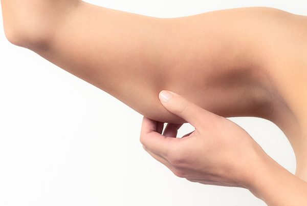 Lifting de braços – Cirurgia de remoção de excesso de pele e gordura dos braços – Vitória – ES.