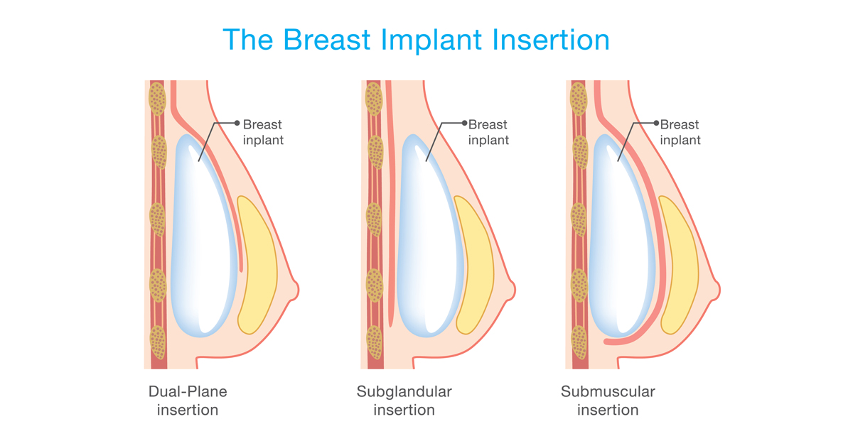 Entenda por que o método Dual Plane de mamoplastia é revolucionário